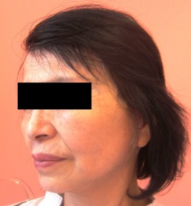 術後1ヶ月　左前斜位